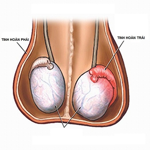 Sưng bìu tinh hoàn - Hình ảnh minh họa